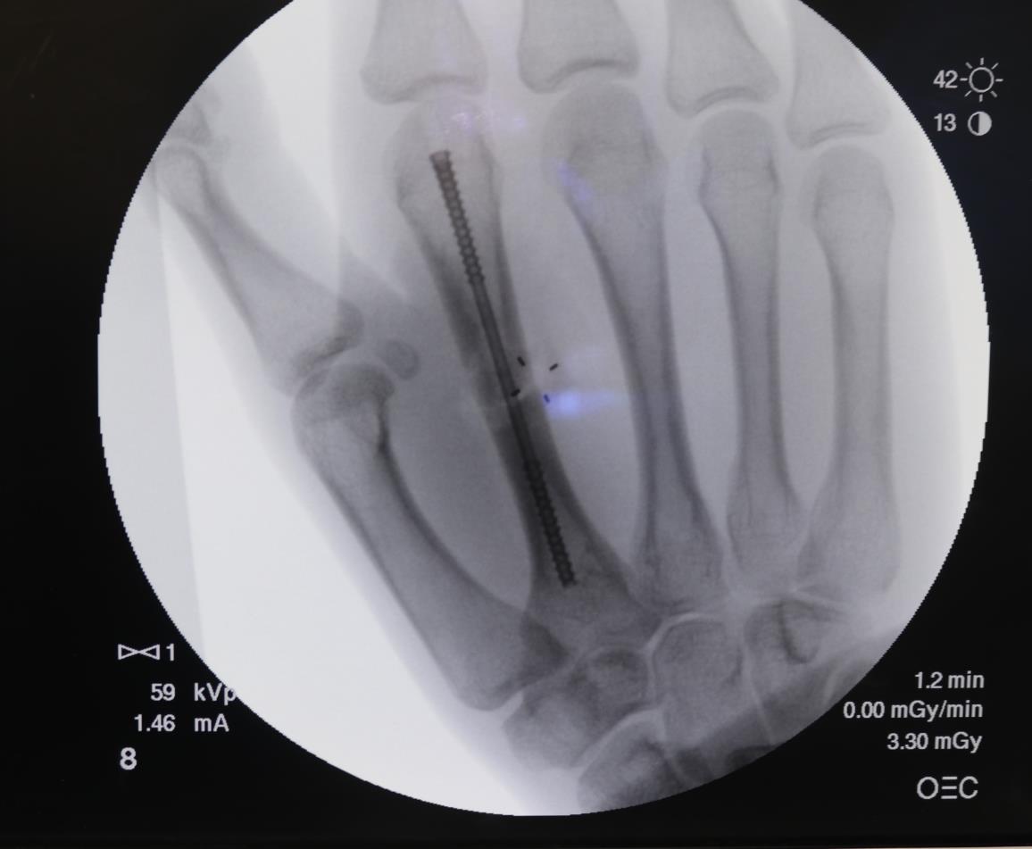Use of NX Nail for oblique fracture fixation of 2nd metacarpal.